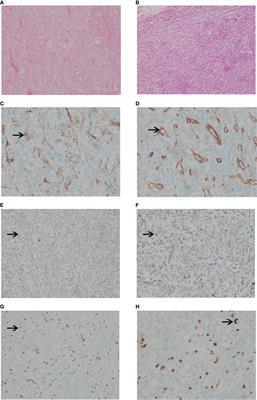 Intracranial solitary fibrous tumor/hemangiopericytoma: Role and choice of postoperative radiotherapy techniques